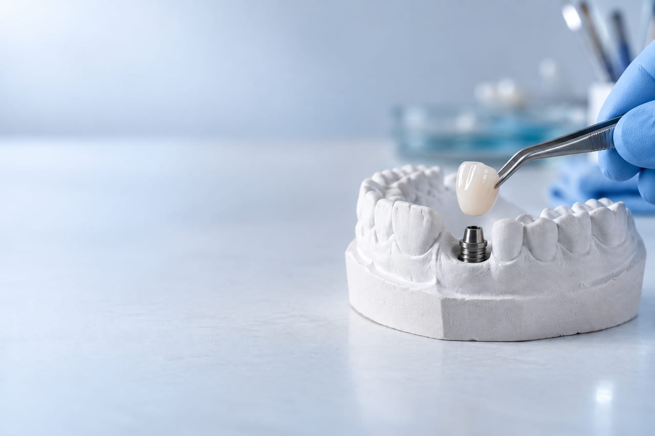 Una corona tenuta con una pinzetta sopra un impianto, in un modello in gesso dei denti